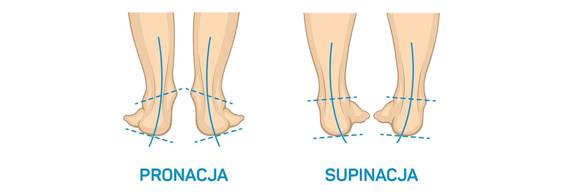 Pronacja oraz supinacja najczęściej występujące wady stóp u dzieci. Idealnym rozwiązaniem są wkładki ortopedyczne FootWave